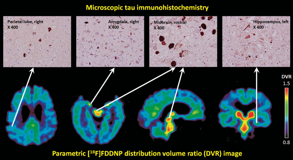 The Neurocritic: Brief Guide to the CTE Brains in the News. Part 2